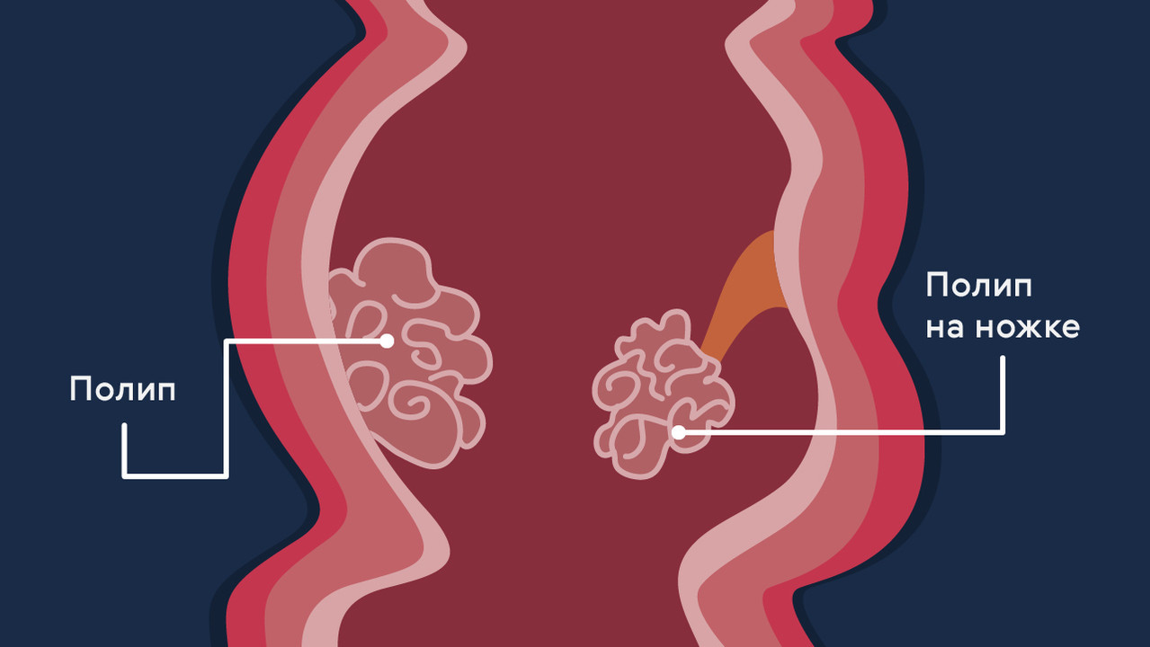 Полипы в области прямой кишки