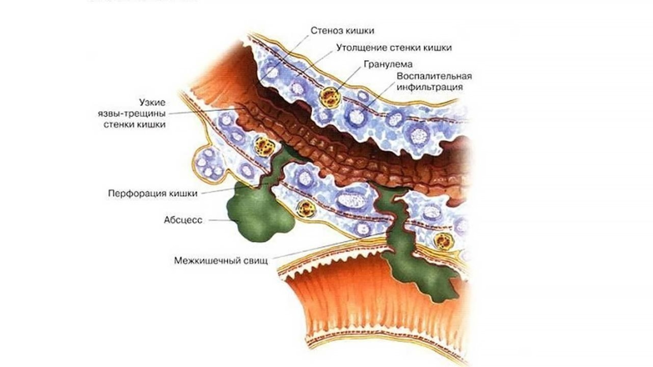 Ассоциация между болезнью Крона, язвенным колитом и острыми артериальными событиями
