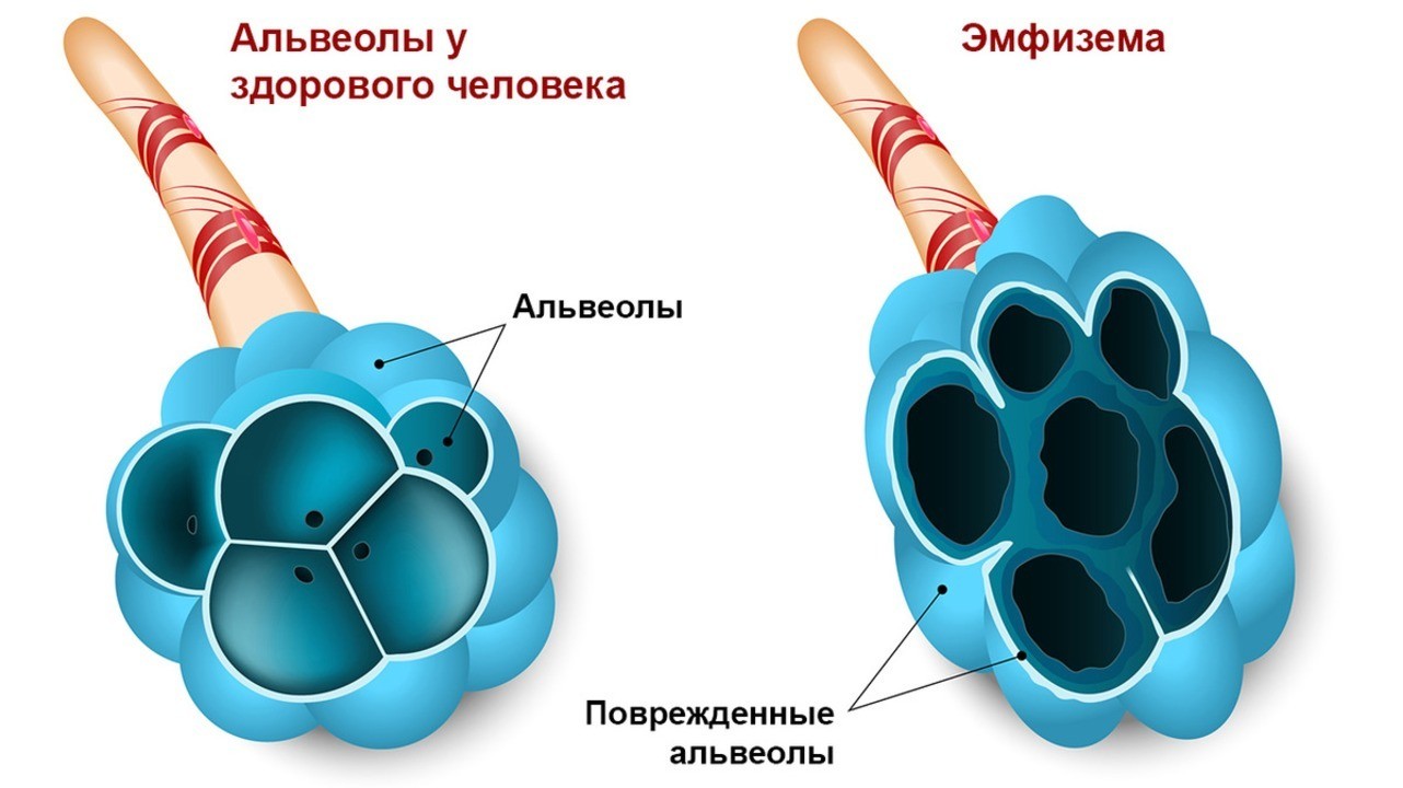 Легкие при хобл картинки