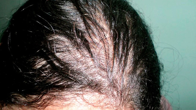 Поредение волос при гипотериозе