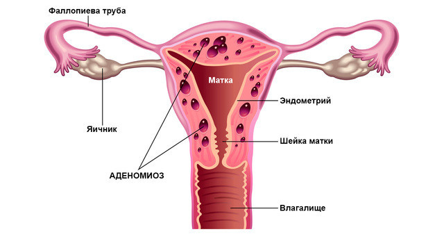 Причины развития эндометриоза: