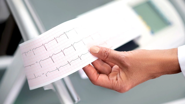 ЭКГ - один из методов диагностики при гипотонии Фото руки, держащей лист бумаги с кардиограммой (ЭКГ). На фоне видны части медицинского оборудования, предположительно, электрокардиографа