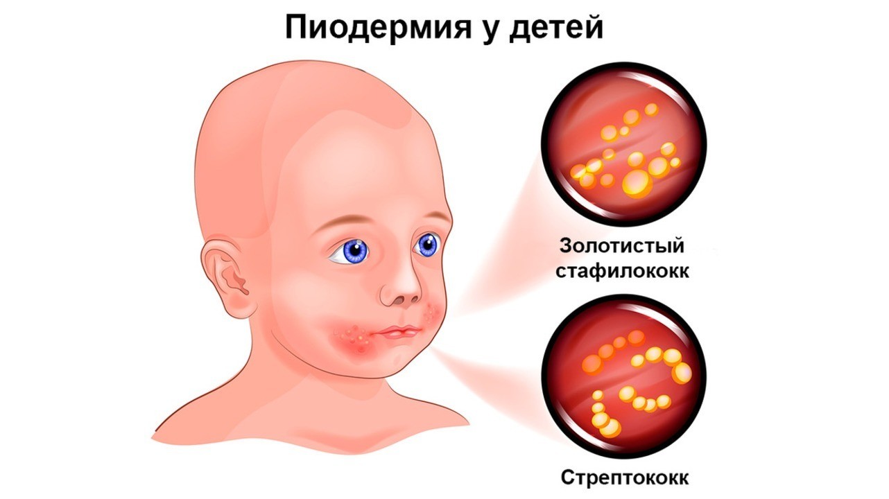Лечение стафилококка у детей