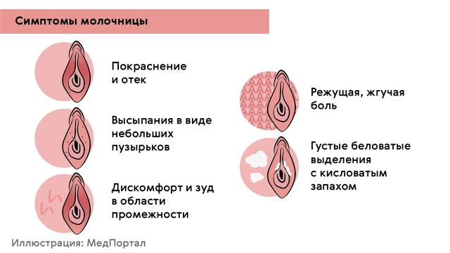 Вагинальный кандидоз (молочница) – симптомы и признаки, лечение в Красногорске