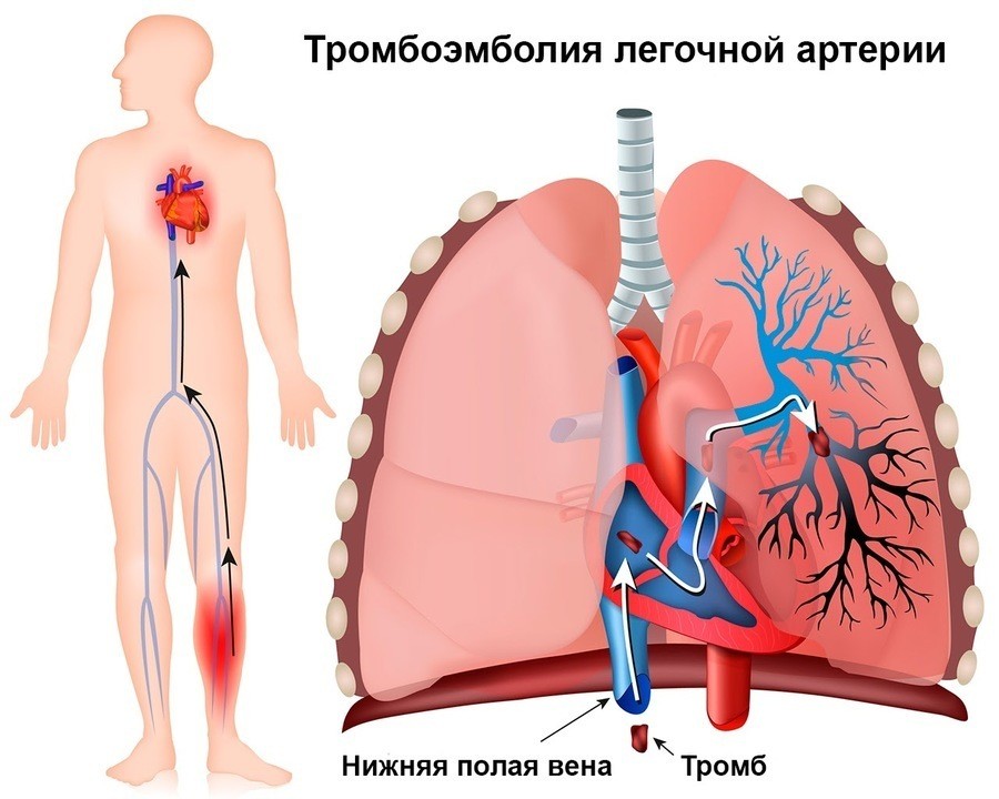 Как нарисовать тромб