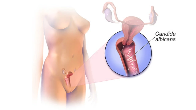 Кандидоз (молочница) у женщин и мужчин: симптомы, лечение, причины, признаки