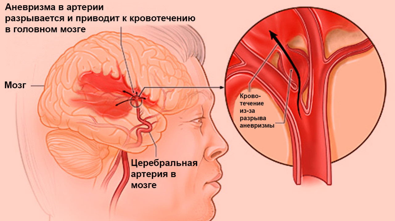 Кровоизлияния головного мозга последствия