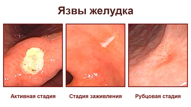 Стадии язвы желудка