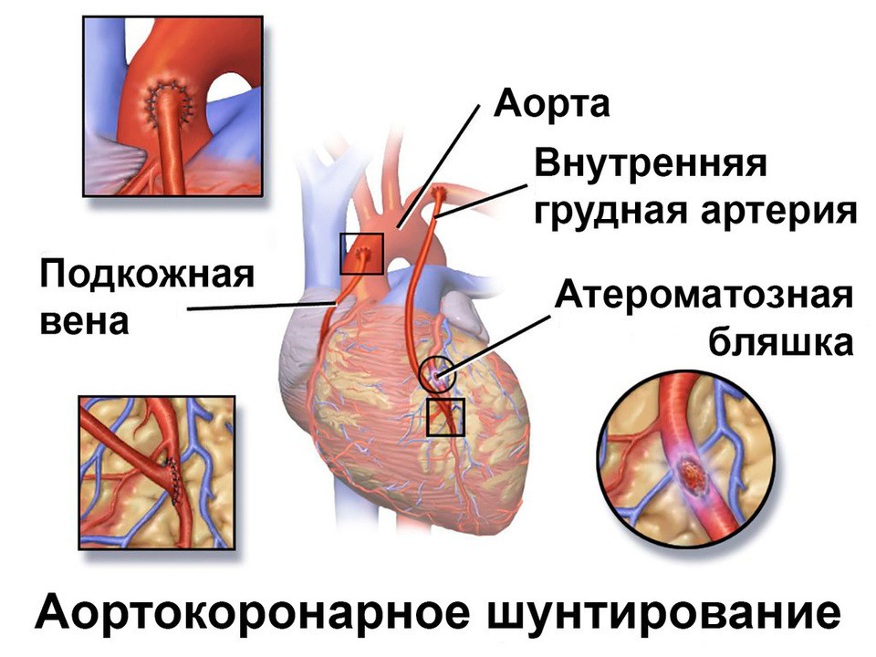 Что такое шунтирование сердца и сосудов. Шунтирование коронарных артерий. Коронарное шунтирование сосудов сердца. Шунт при инфаркте миокарда. Коронарное шунтирование сердца при инфаркте.