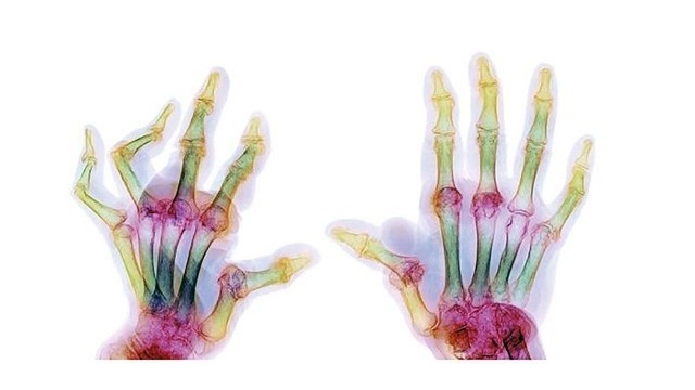 Ревматоидный артрит – причины возникновения и лечение