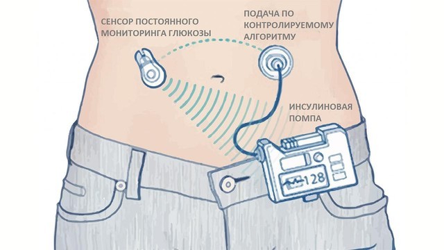 Как выглядит инсулиновая помпа на человеке фото