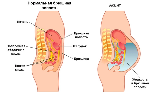 Нормальная брюшная полость и асцит