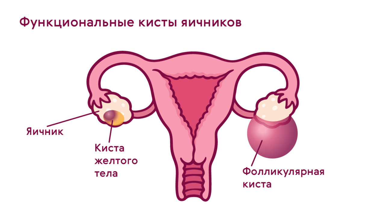Киста яичника: симптомы у женщин и девушек, признаки кисты, причины появления, лечение - причины, диагностика и лечение