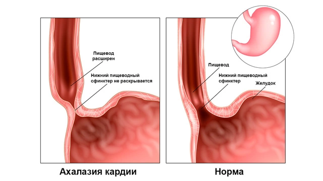 Норма и ахалазия кардии Норма и ахалазия кардии