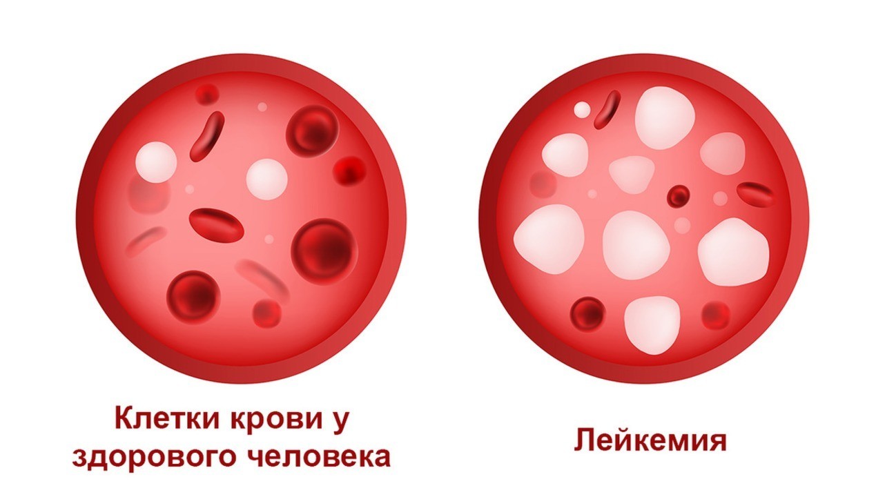 Лейкоцитарная формула (Differential White Blood Cell Count, лейкограмма)