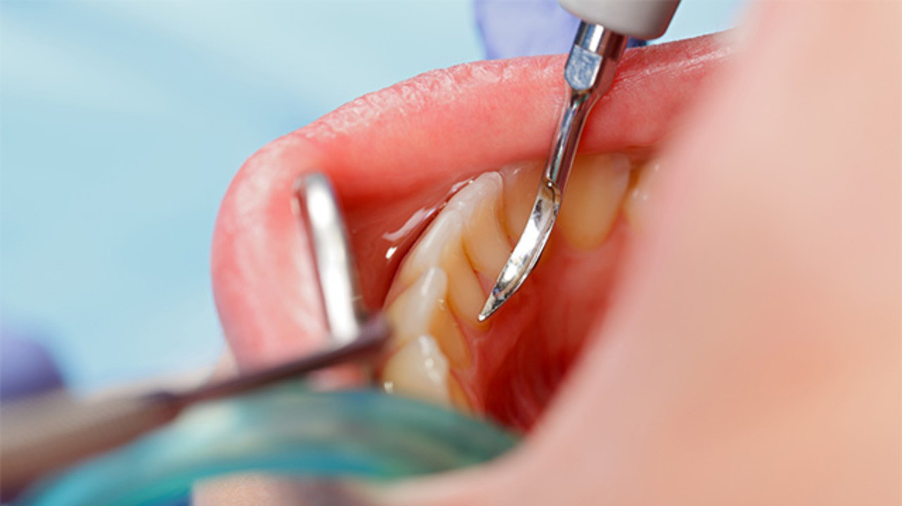Зубной камень: причины, признаки, осложнения