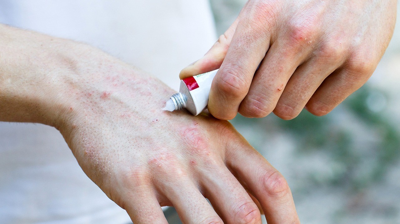 dermatitis az ujjak között férgek a gyermekben hánynak
