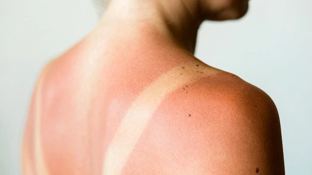 Солнечный ожог: что делать для спасения кожи