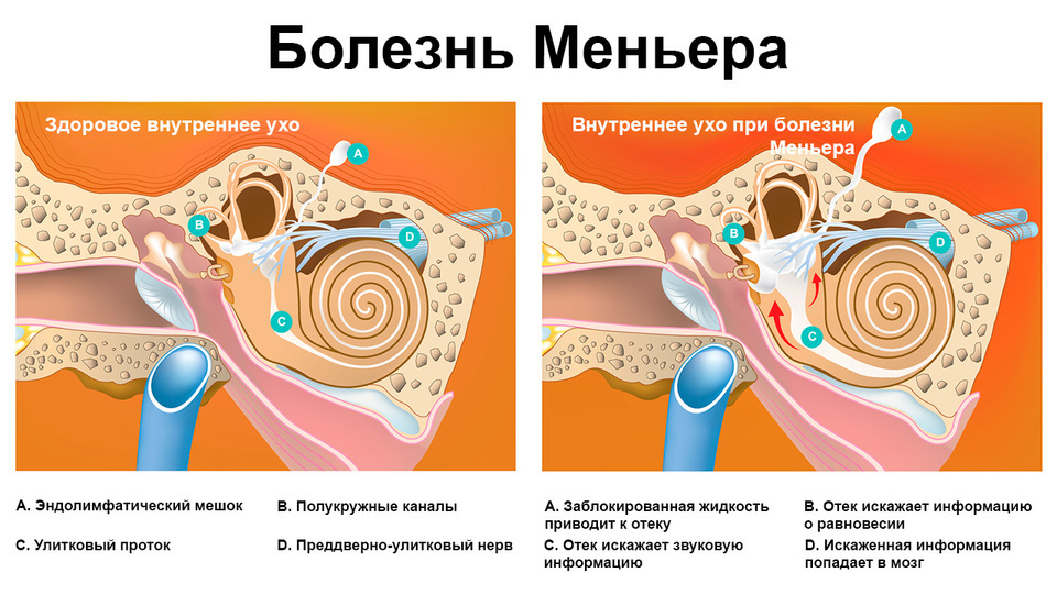 Нарушение внутреннего уха. Болезнь Меньера гидропс. Болезнь Меньера отоларингология. Болезнь Меньера эндолимфатический гидропс.