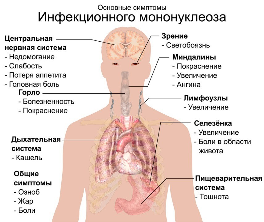 Инфекционный мононуклеоз: симптомы и лечение