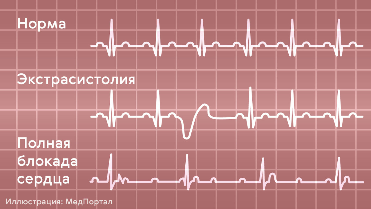 Как выглядит экстрасистолия на экг фото