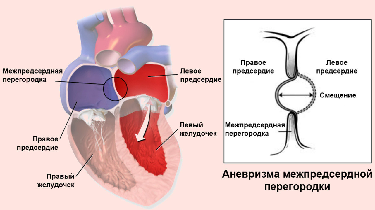 Ученые смогли остановить и обратить развитие фиброза в сердце