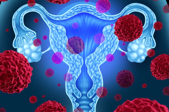 Рак шейки матки: причины, признаки, лечение