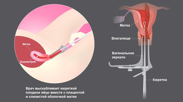 Рисунок 1. Инструментальный аборт Схематическое изображение женской репродуктивной системы во время инструментального аборта. . Слева находится увеличенный фрагмент, показывающий детали маточной трубы и яичника. Справа - более общий вид матки, влагалища и медицинского инструмента