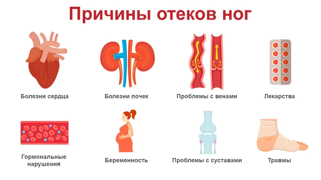 Причины отеков ног На изображении показаны восемь различных причин отеков ног