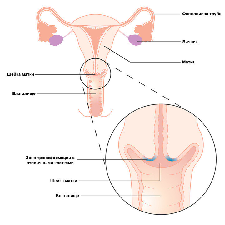 Дисплазия шейки матки - симптомы и лечение