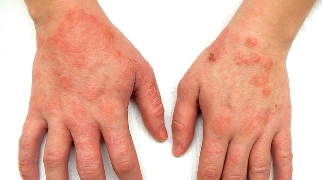 Что такое атопический дерматит? - Братский областной кожно-венерологический диспансер