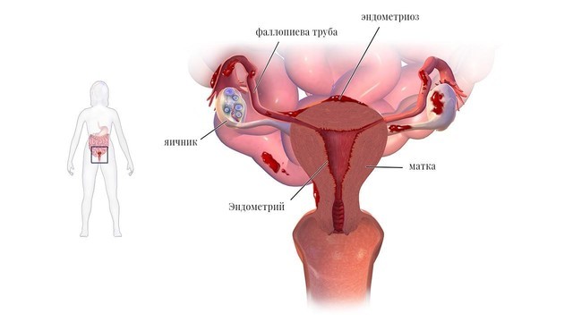 Эндометриоз матки: формы заболевания
