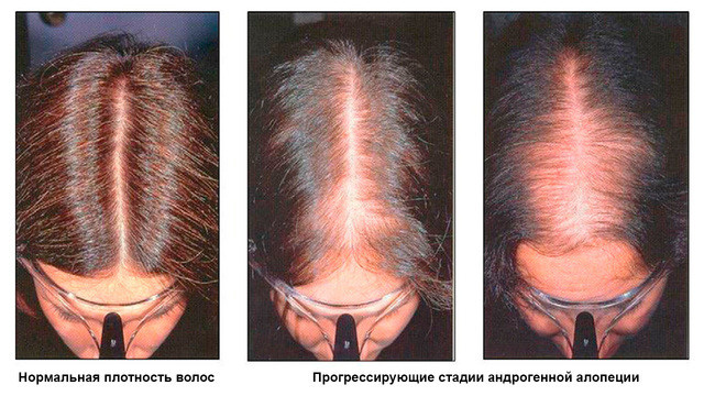 Почему выпадают волосы на лобке у мужчин?
