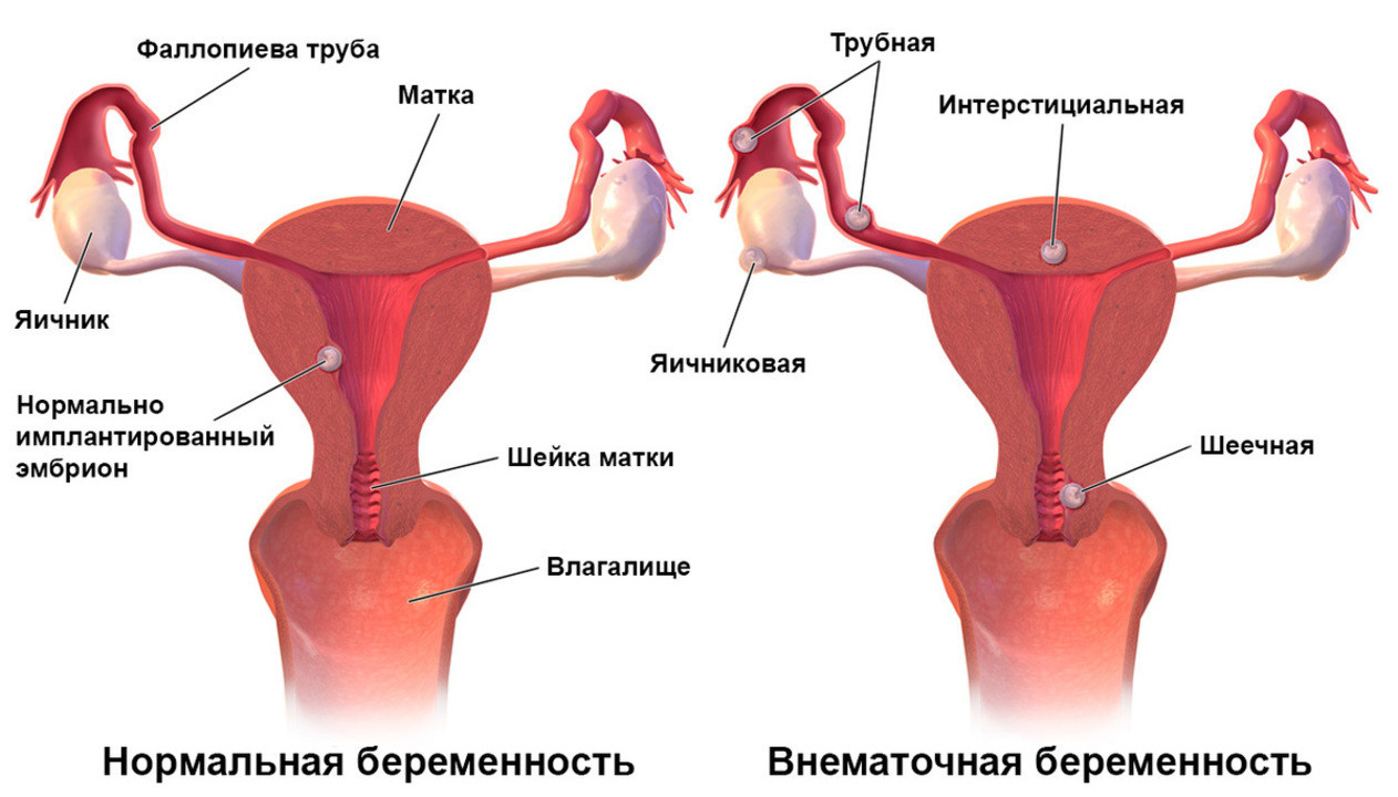 Матка и маточные трубы беременность