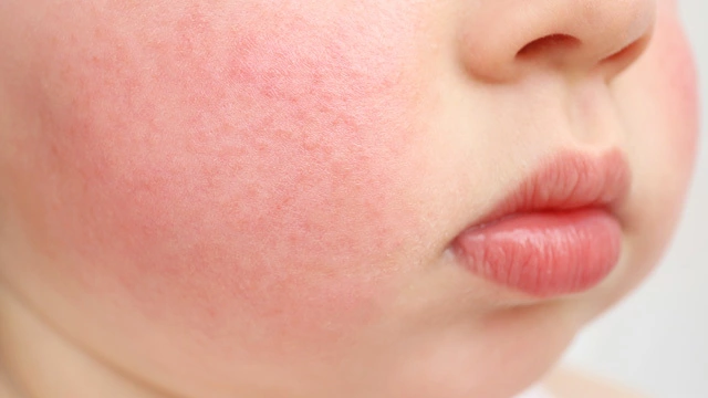 Аллергический диатез у детей