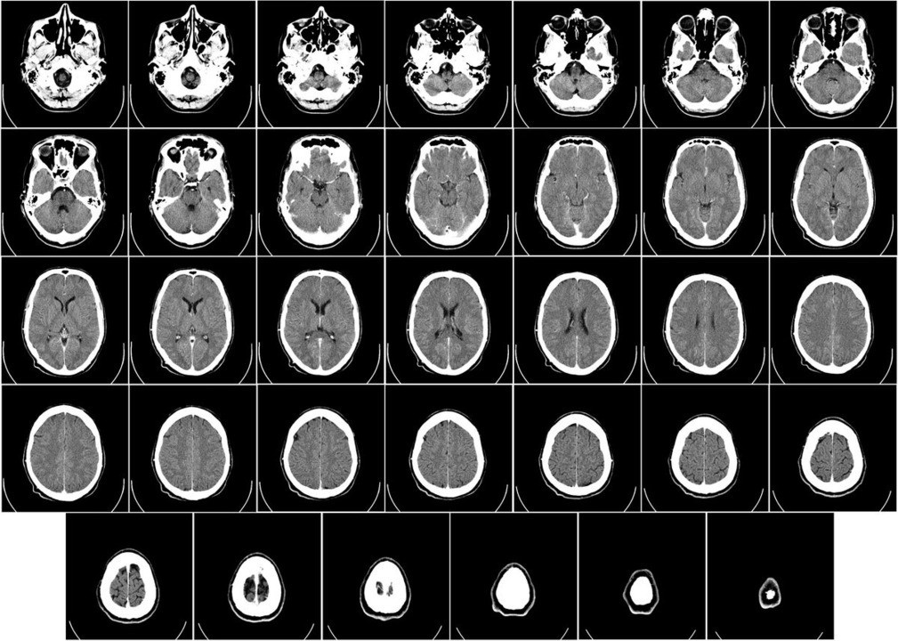 Кт головного мозга картинки