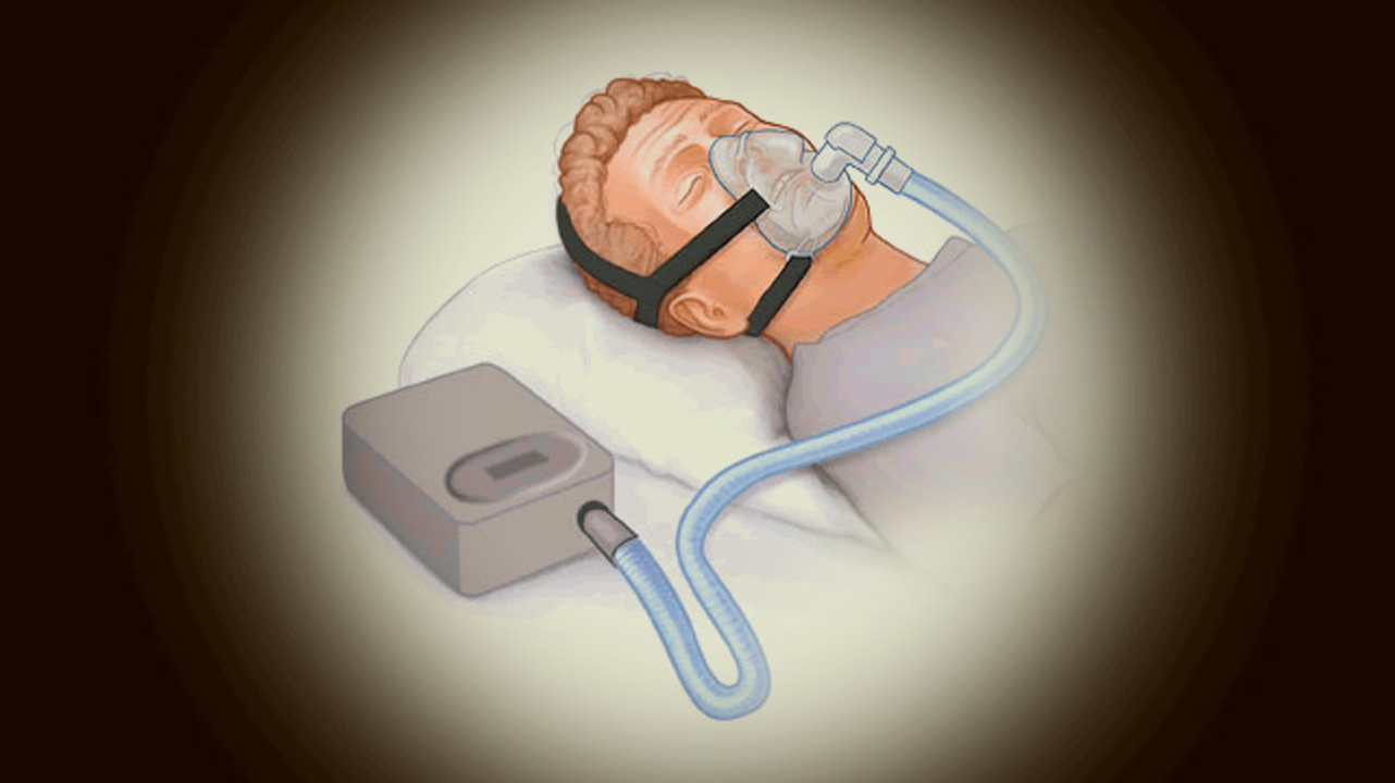 CPAP-терапия