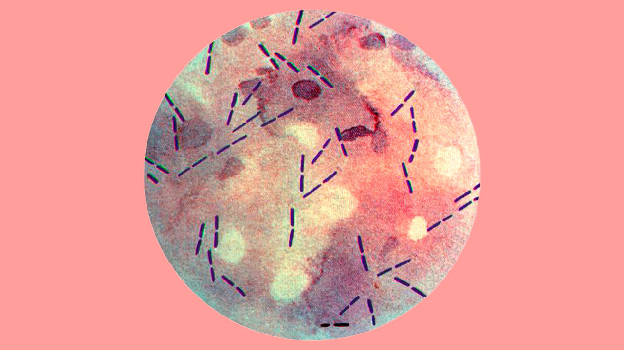 Анаэробная инфекция мягких тканей тест нмо с ответами для врачей на сертификат