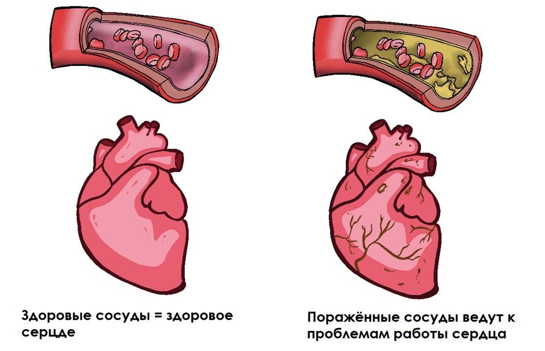 Атеросклероз артерий сердца