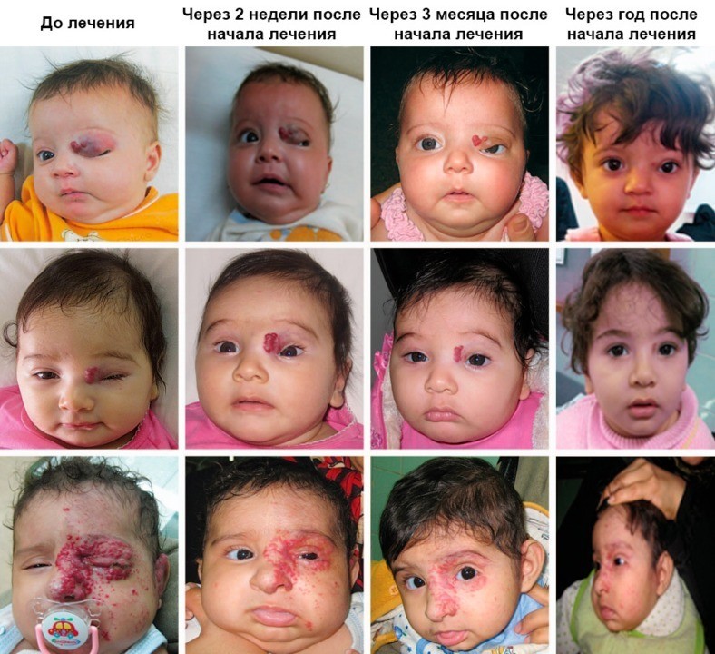 Лечение младенческих гемангиом и последствий других сосудистых аномалий