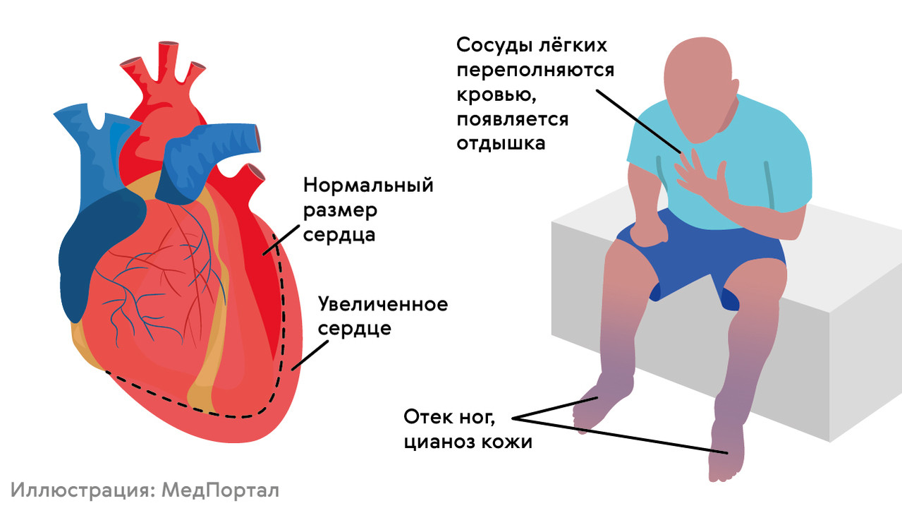 Блокада болезнь. Блокада проводящей системы сердца ЭКГ. Типы блокад сердца на ЭКГ. Блокада сердца симптомы. Проявления блокады сердца.