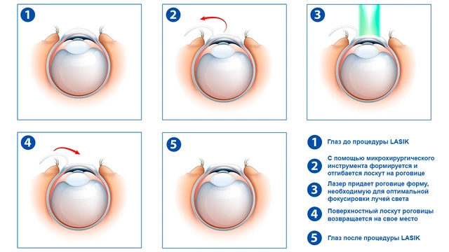 Как проходит операция LASIK Схематичное поэтапное изображение операции LASIK (лазерный кератомилез) на верхнем слое роговицы глаза