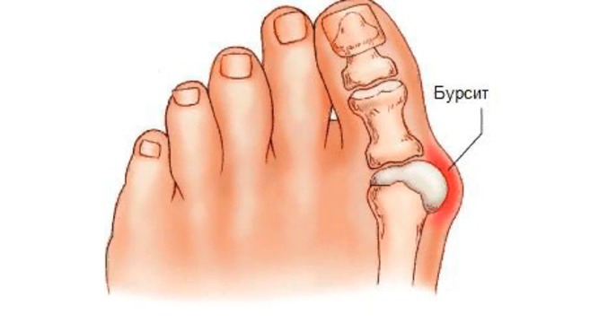 Косточка на ноге: как лечить вальгусную деформацию?