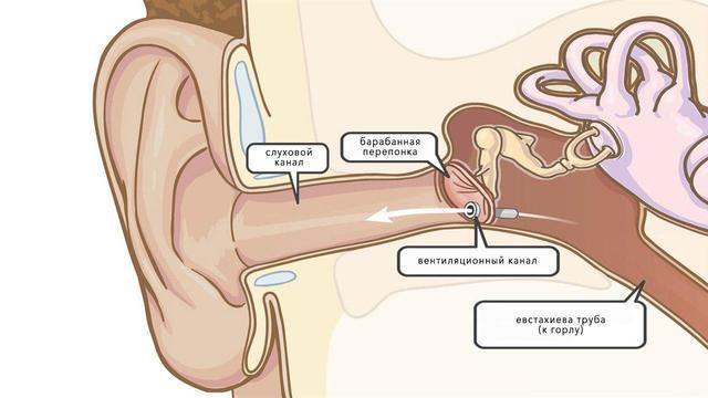 Миринготомия уха - что за операция и как проходит?