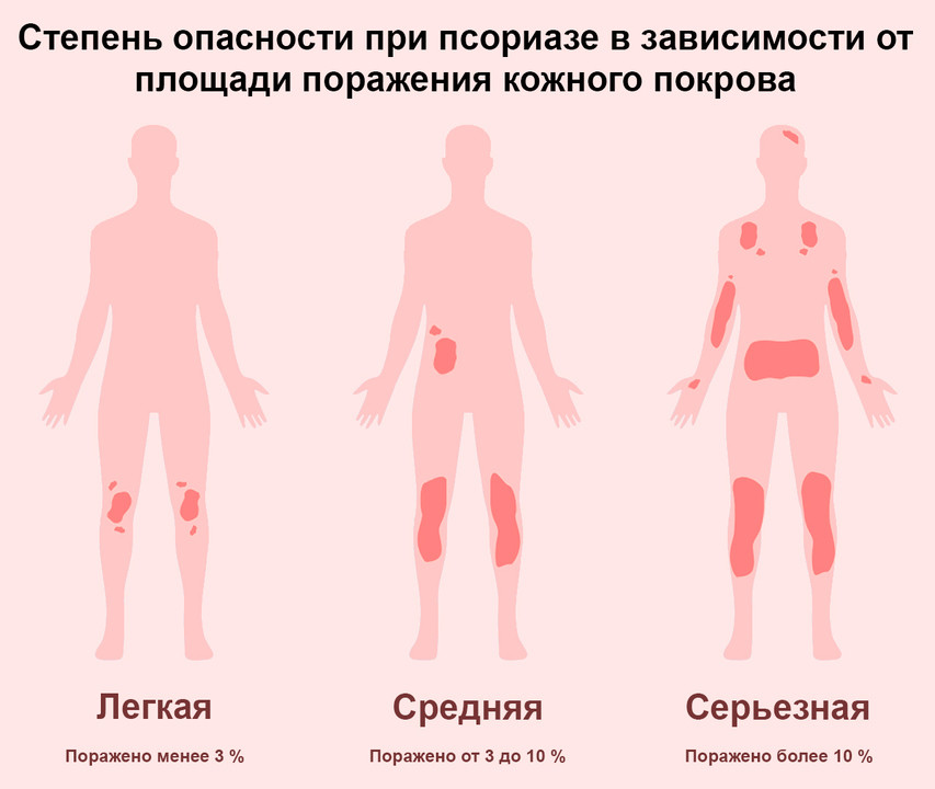 Лечение псориаза в Челябинске