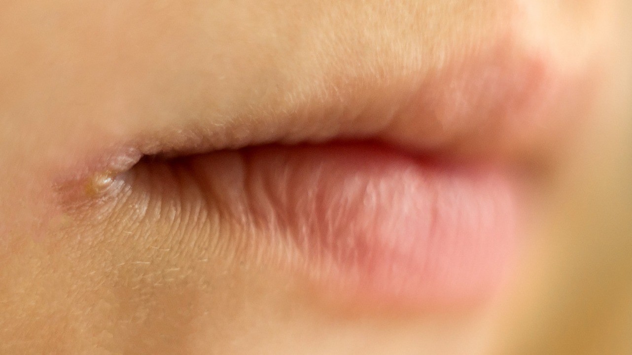 Как вылечить заеды на губах при беременности?