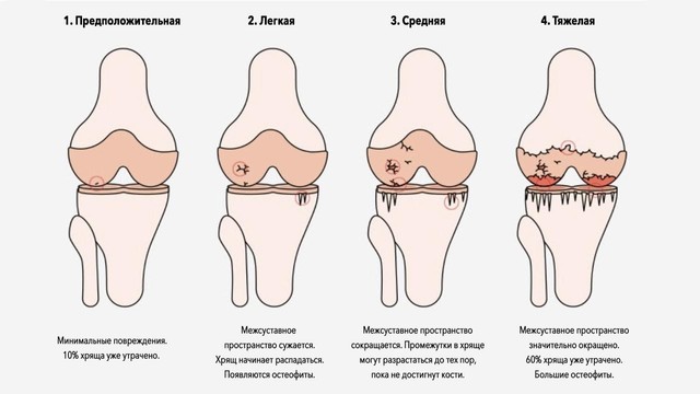 Разрыв коленного хряща: симптомы и лечение