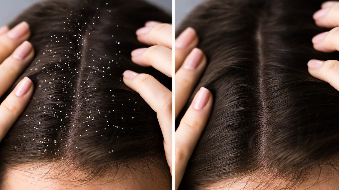 Выпадение волос при себорее