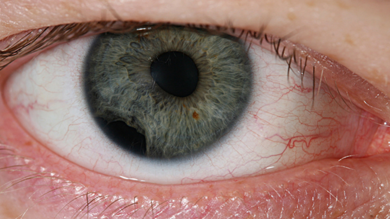 Повреждения органа зрения