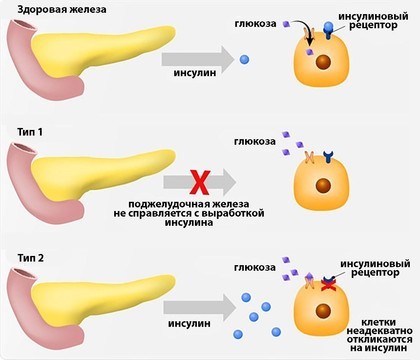 Повышенный сахар при диабете 1 типа